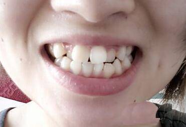 牙齿特别大面相_牙齿长的男人面相_牙齿大面相