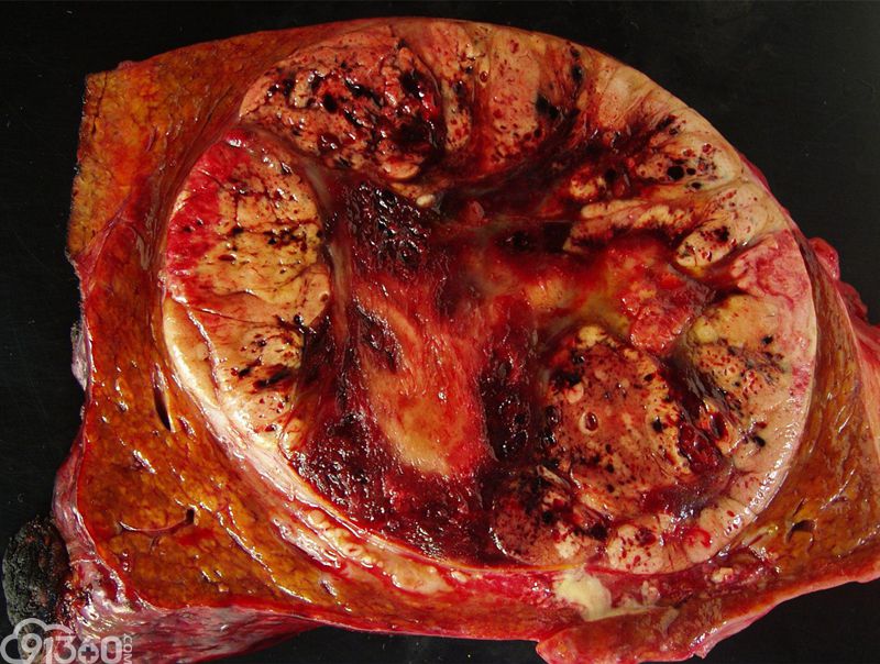 胰腺头癌手术能活多久_胃异位胰腺会变癌吗_八字中怎样看胰腺癌