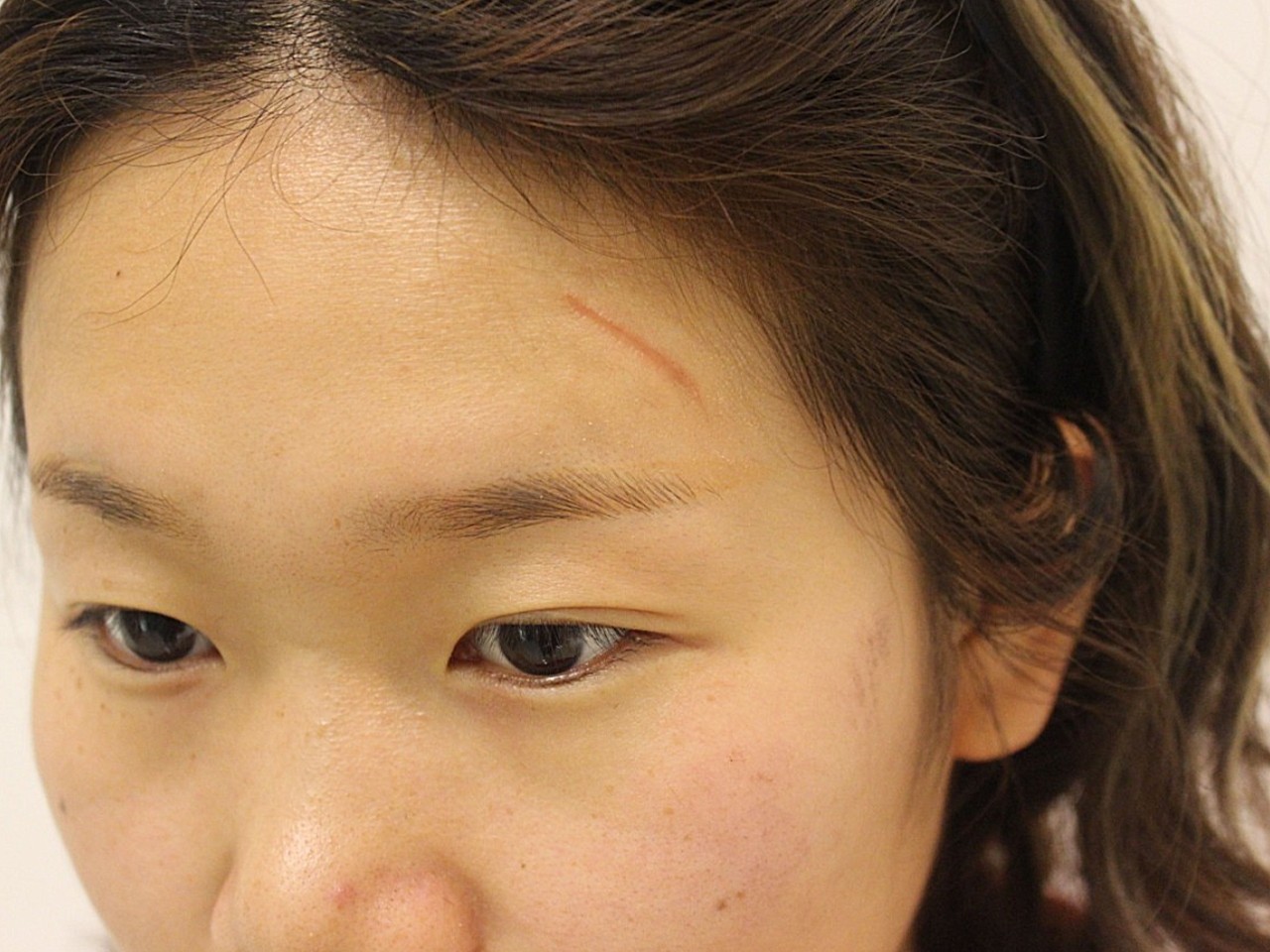 额头有伤疤影响命运吗_额头有伤疤代表什么_额头有伤疤的面相